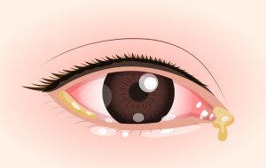 結膜炎 保谷駅前つだ眼科